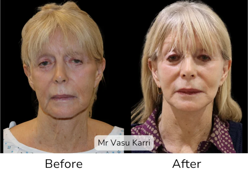 Facelift Patient 6 View 1